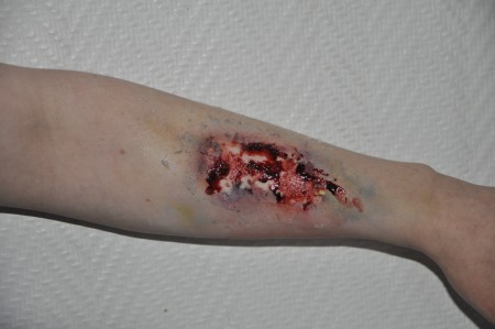 halvläkt (halvt avtvättat) sår